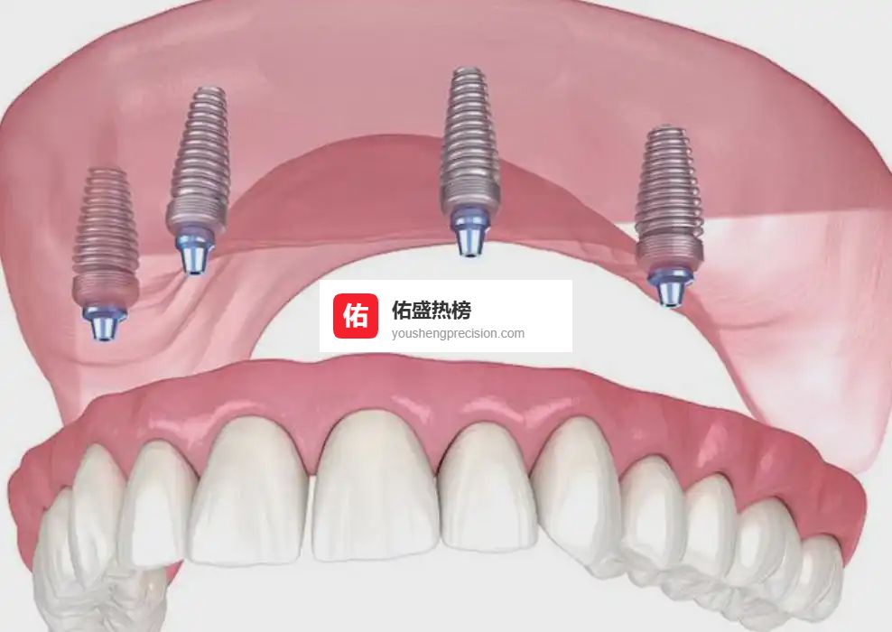 血泪案例：68岁阿姨花1.8万种牙，半年全掉光！这三类老人千万别种牙，否则钱牙两空！