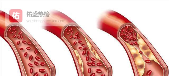 血脂高的人注意：晨起睡前有禁忌，日常三事要牢记