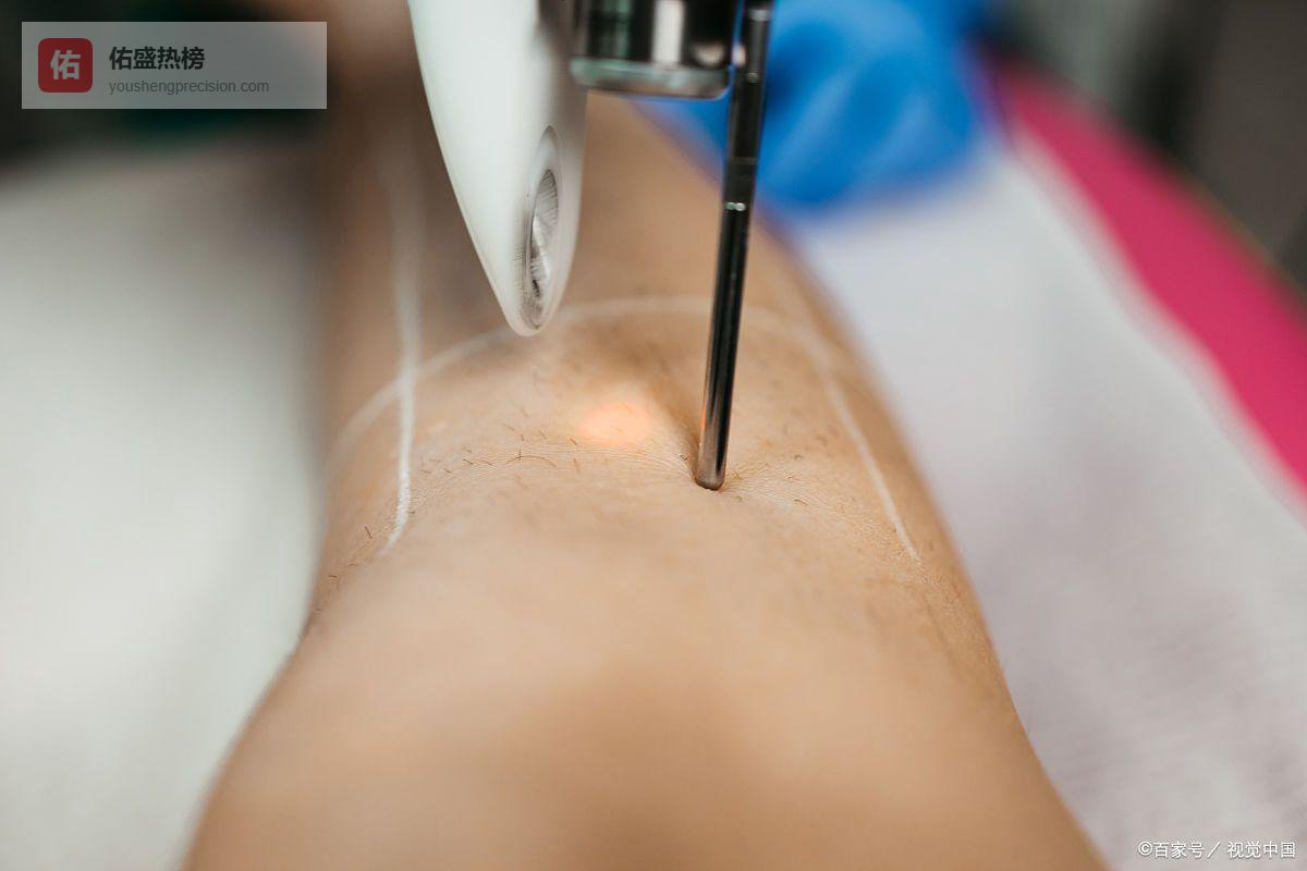 告别反复刮毛！脚毛永久去除全攻略，教你选对方法+做好护理，轻松拥有光滑双脚