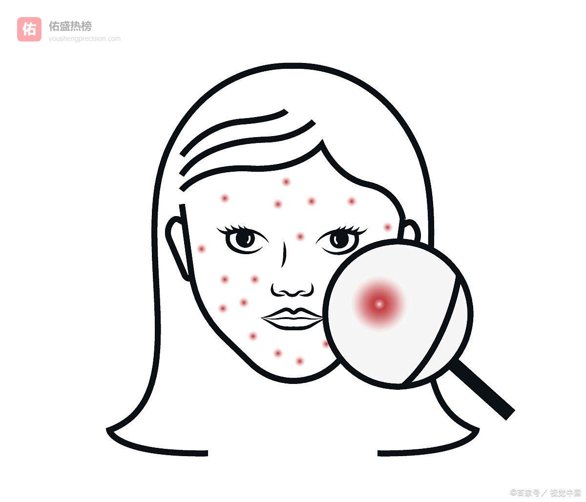 痤疮总不好？了解成因才能科学战“痘”