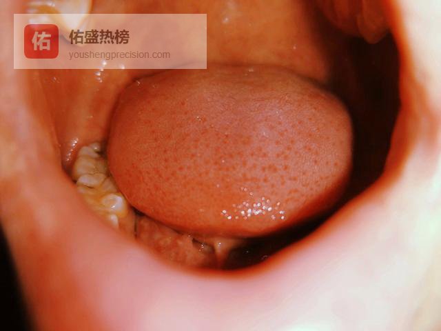 舌头反复有烧灼感疼别不当回事，这些常见诱因早排查早改善！