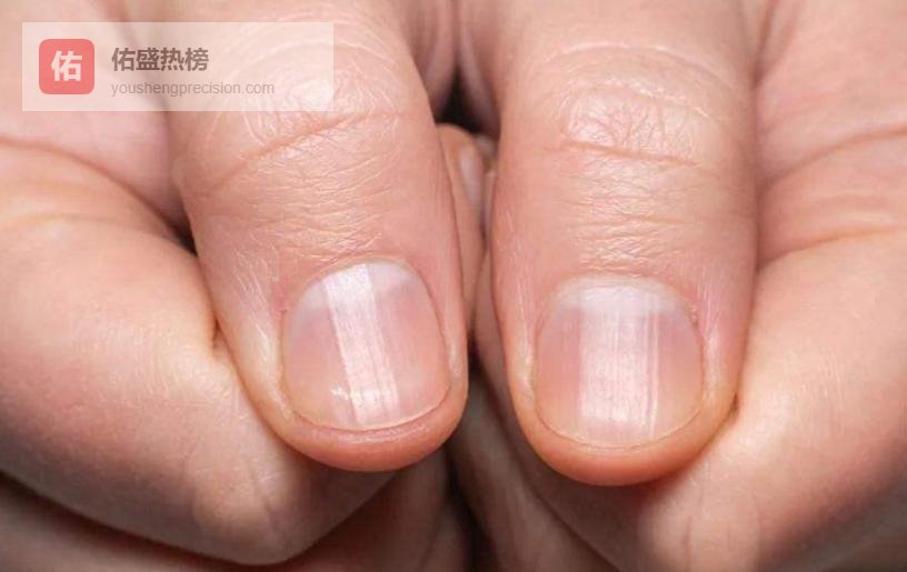 指甲竖纹真相：身体悄悄亮起的警报灯