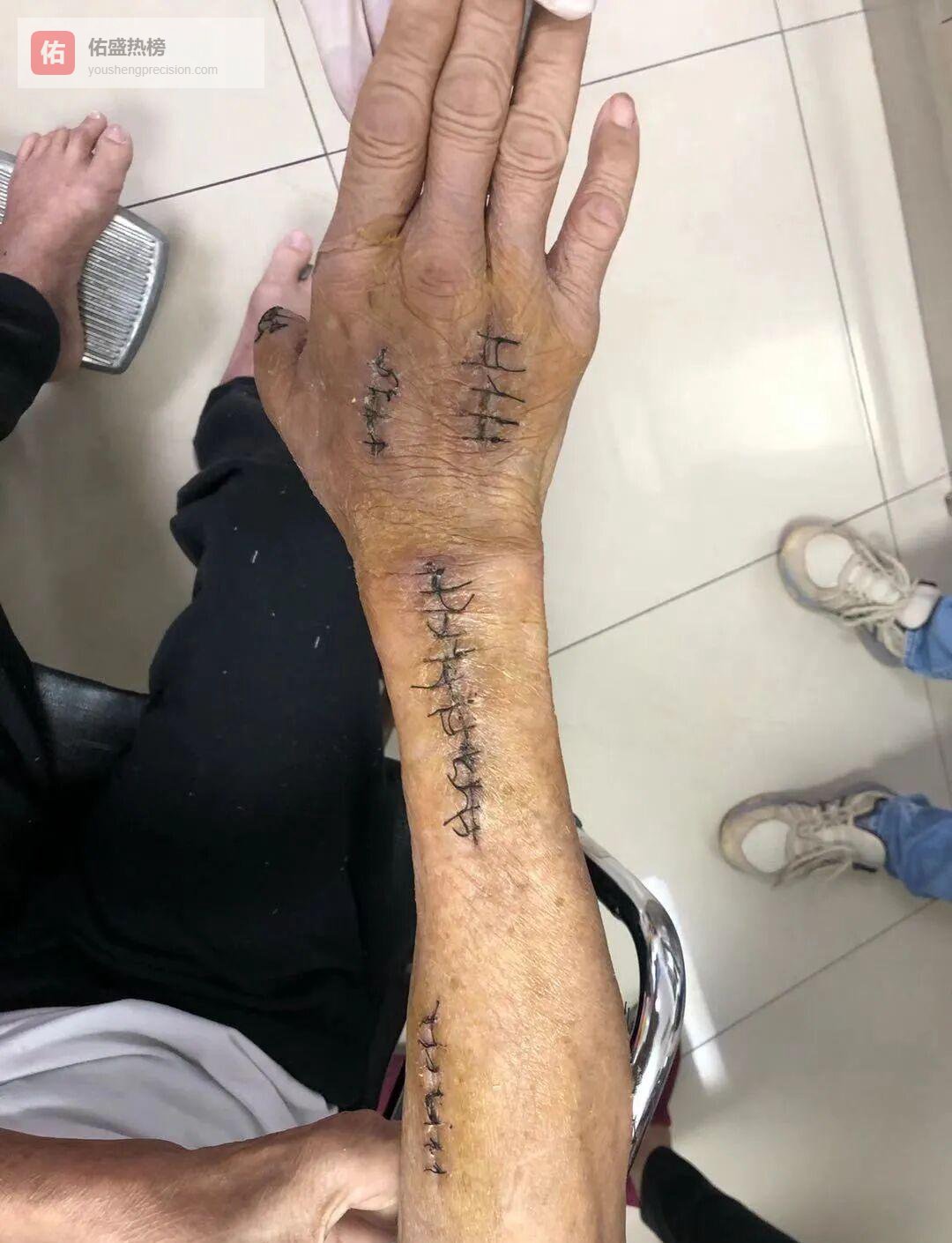 一只海蟹差点要命：海洋创伤弧菌的真相与自救指南