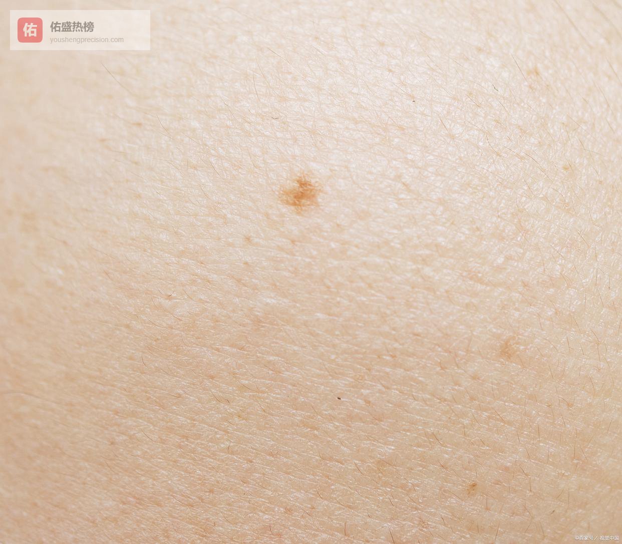 点痣后到底能不能碰水？这些注意事项你一定要知道