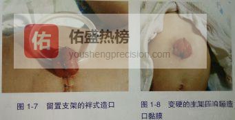 肠造口支架管别拖：10～14天是黄金拆管期