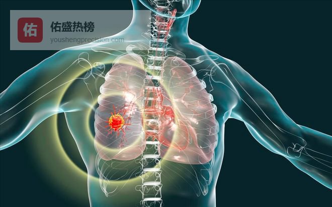 没有烟草，肺癌会不会成为一种罕见病，这里实话实说一下