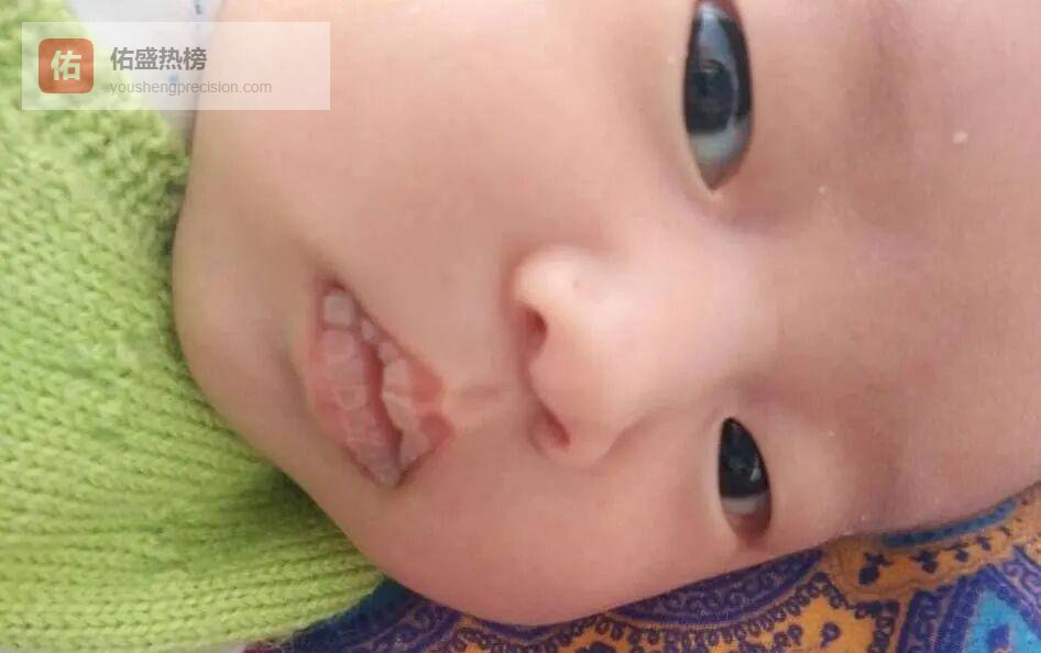 宝宝嘴唇“白泡”怎么办？新手爸妈急救指南