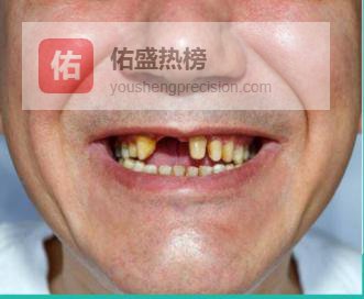 已离职！三甲牙医揭露那些不为人知的种牙风险！90%的人种牙都忽略，种牙8年的过来人警告：种牙后千万别碰8个雷区，给所有种牙人敲警钟