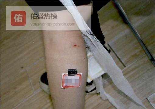 酒后碎瓶追人反被扎伤，责任到底归谁？