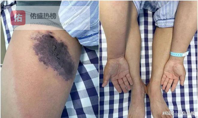 男子穿旧牛仔裤被蜘蛛咬伤中毒，大腿内侧布满了大片红斑