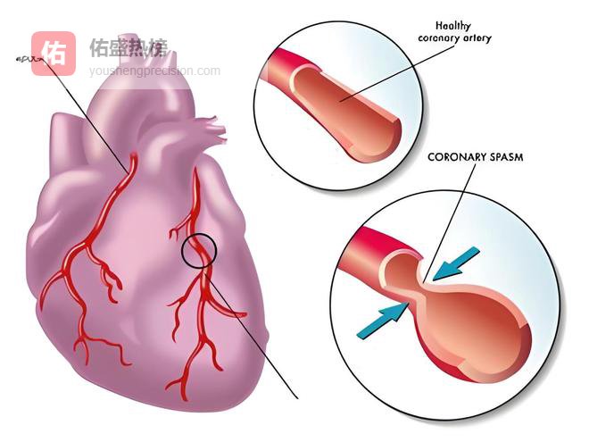 冠脉狭窄不严重却突发心梗、猝死？医生揭秘两大元凶