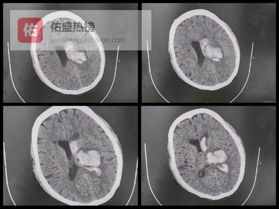 代价太重！得这病长期不重视，东莞这名40岁男子…