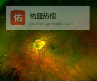 “豹纹状眼底”是一种病吗？