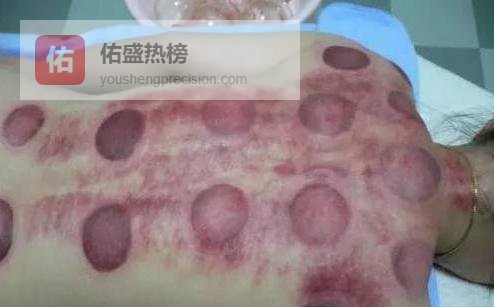 罐印里藏着的健康密码