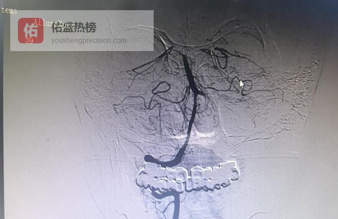 87岁老人突发脑梗命悬一线，多学科协作上演“生命奇迹”